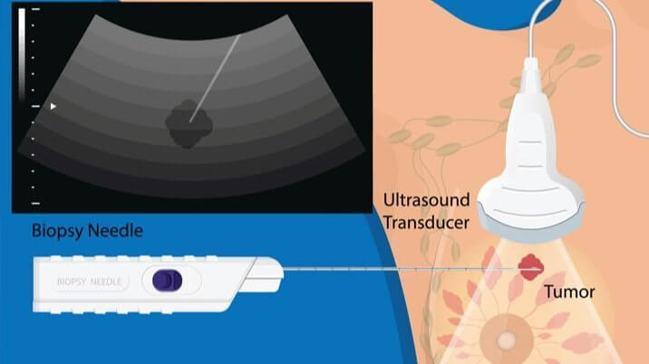 The future of breast cancer treatment