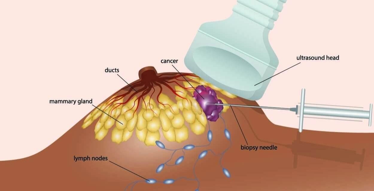 Procedures: When is a breast biopsy needed?